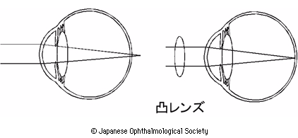 引用：日本眼科学会